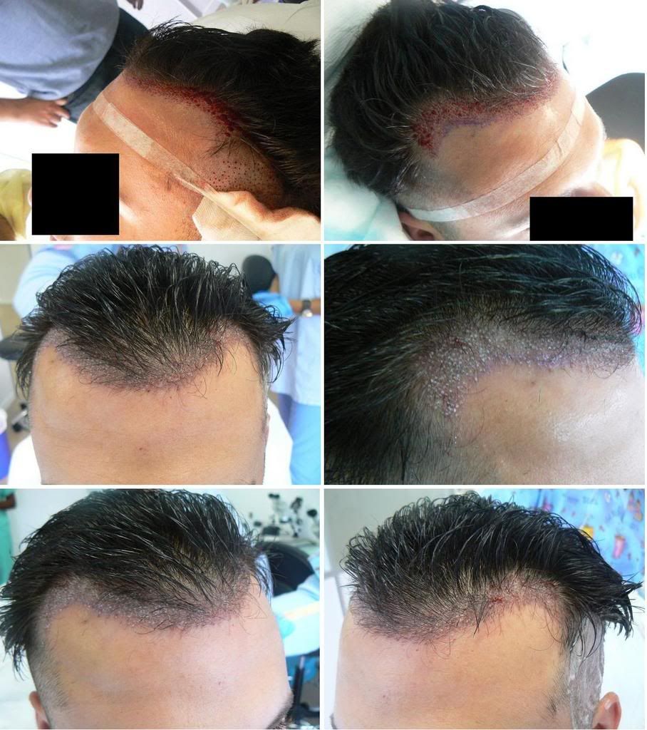 Alopecia, hair growth, hair transplant cost,Hair Transplant Reviews